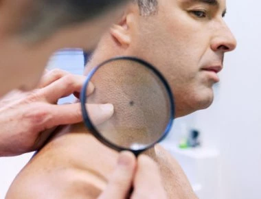 Και όμως αληθινό: Καρκίνος «Μέρκελ» - Ταχεία εξάπλωση (φωτό, βίντεο)